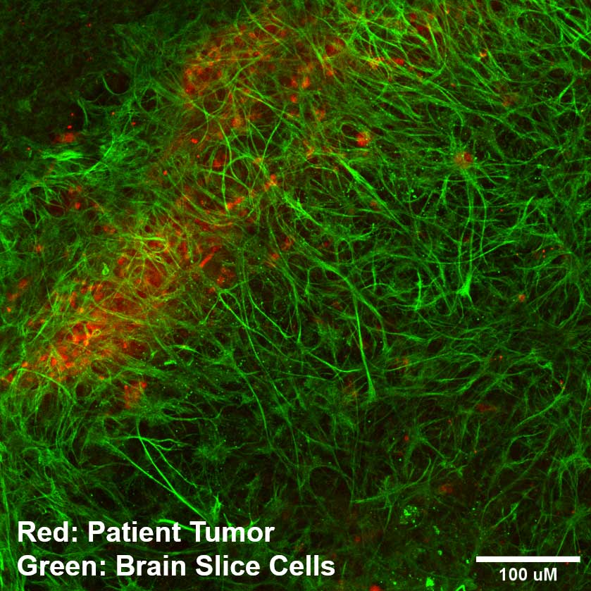 patient tumor binding to the brain slice cells - courtesy of Andrew Satterlee
