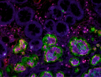 Thin tissue section stained with markers for Intestinal Neuroendocrine Tumors (NETs).