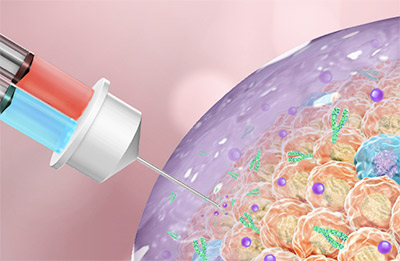 When injected into tumors, this therapy forms a gel to attack cancer cells.